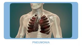 Pneumonia and the role of community health workers