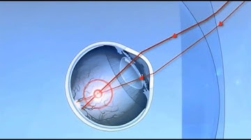 Why free form digital lenses?