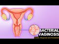 Bacterial vaginosis, Causes, Signs and Symptoms, DIagnosis and Treatment.