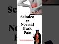 Back pain aur sciatica same nahi hote ⚠️Sciatica me pain nerve ke through leg tak travel karta hai.
