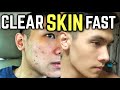 10 Skin Care Tips For Men Philippines | Paano Mawala ang Pimples?