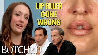 Keara Hasn't Closed Her Mouth in 10 Years After Bad Lip Injections (Before & After) | Botched | E!