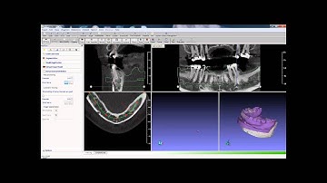 GuideMia Demo: Optical Scan Case part1.wmv