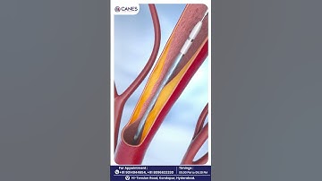 What is CTO? | Dr. Lakkireddy Explains Chronic Total Occlusion | Canes Cardio & Neuro Clinic | CTO |