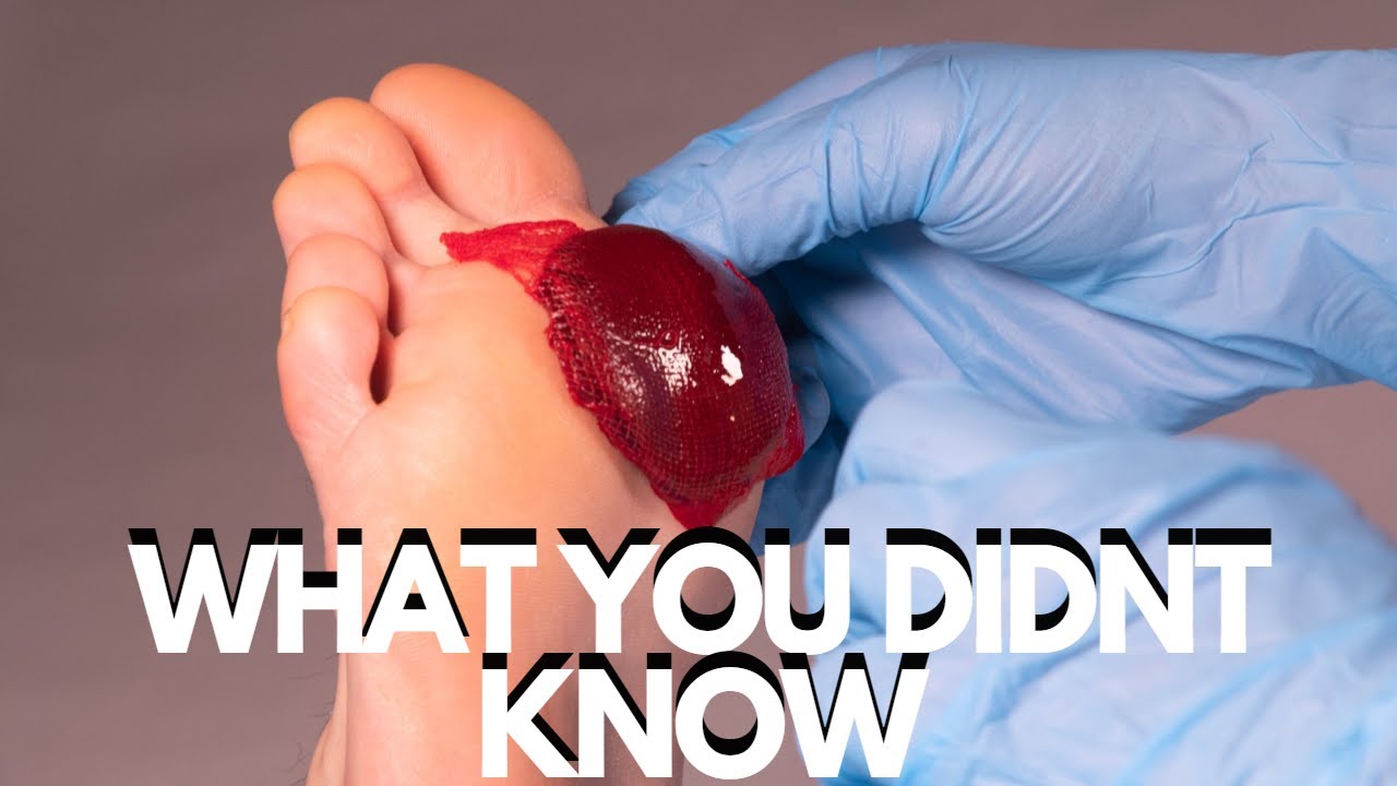 15 COMMON SIGNS OF BLOOD CLOTS YouTube