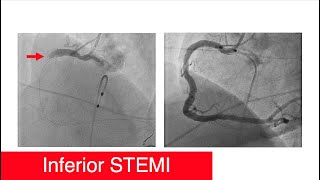 Inferior STEMI, Dont Give Nitro, Cath Images[Part 5]