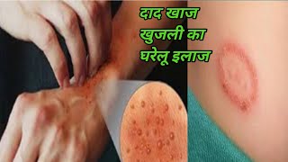 दाद खाज खुजली को ठीक करने का घरेलु इलाज | Home Remedies For Ring Worms | By Bite of Health Hindi