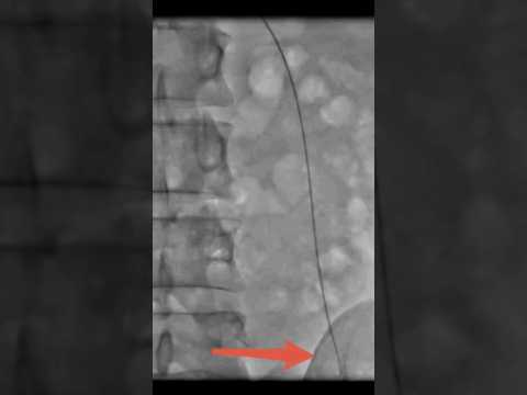 Varicocele embolization live