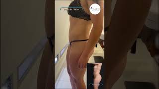 Lipolipecto Más Marcación Abdominal Más Pexia Con Implantes Nuara Esencia De La Belleza