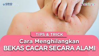 Cara Menghilangkan Bekas Cacar Secara Alami, Wajib Coba Sekarang Juga Cara Menghilangkan Bekas Cacar Secara Alami, Wajib Coba Sekarang Juga