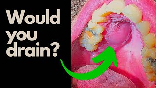 Tooth Abscess - Would you INCISE and Drain this Abcess?