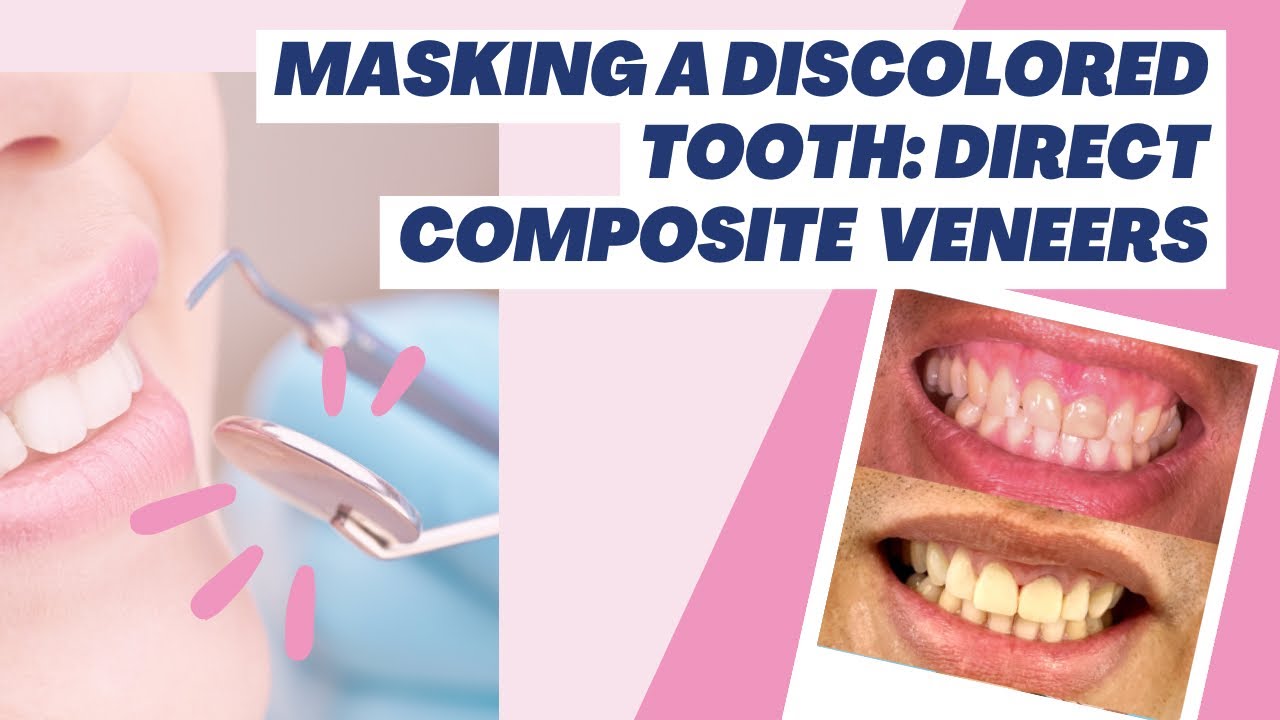 Direct Veneers on a Discolored Tooth (with Composite Resin) YouTube