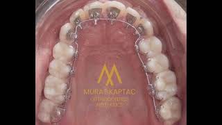 Gizli Tel ile Gizli Değişim 🇺🇸 Secret Change with Invisible Braces