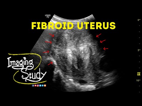 Video: Fibroids Og Graviditet: Hva Du Bør Vite