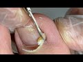 Must see ! Never know so much cuticle hiding under nail