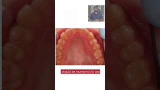 Class 1 Malocclusion Part 4 - Examination of the palate for swellings, indentation or any anomaly. Swelling Of The Palate