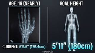 I Analyzed His Growth Plates - How Much Height Does He Have Left