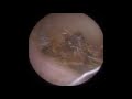 Dry and Hairy 'Strands' of Ear Wax Removed using iCLEARscope® - Mr Neel Raithatha (THC)