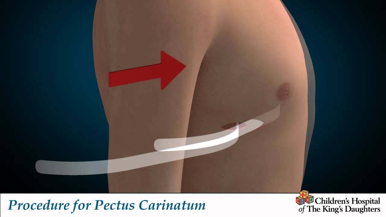 CHKD Carinatum