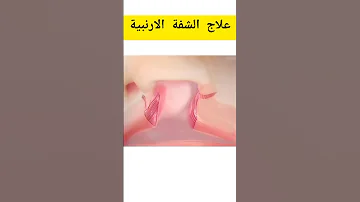 عملية علاج الشفة الارنبية Shorts 