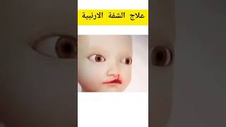 عملية علاج الشفة الارنبية#shorts