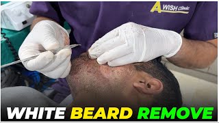 White Beard Remove By Fue Method | Awish Clinic | #viral #whitebeard