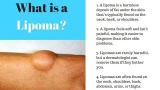 लिपोमा (चर्बी की गांठ) क्या है ? Lipoma Treatment