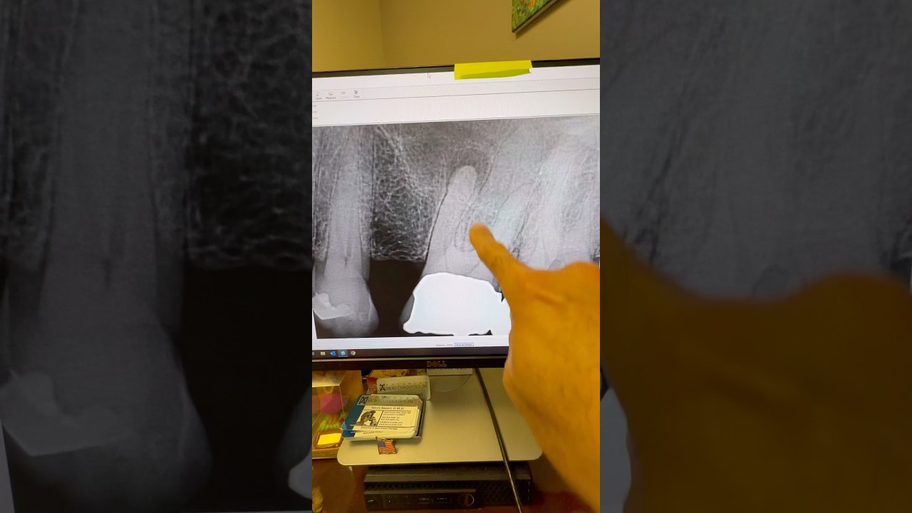 82-year old needed a root canal on this calcified #14. 