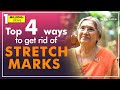 How to get rid of stretch marks | Dr. Hansaji Yogendra