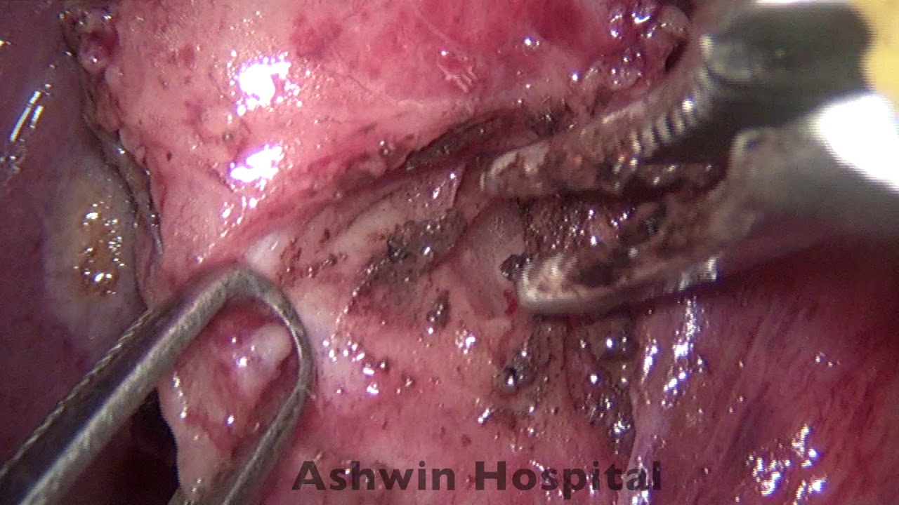 video phone beyonce mp3 Difficult Laparoscopic Cholecystectomy for empyema gall bladder post ERCP