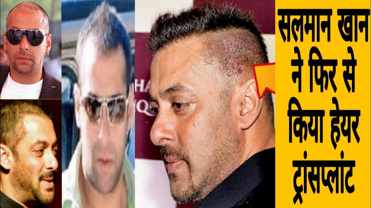 Case Study Salman Khan Hair Transplant Video || Rich Bollywood Celebrity Hair  Transplant - YouTube
