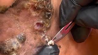 Chrispus Feet Deformed Because Of Jiggers - Watch Full Video Subscribe