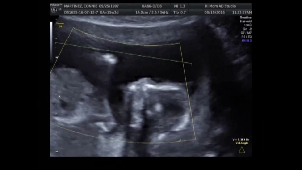 15 weeks 4D Ultrasound It's a boy! YouTube