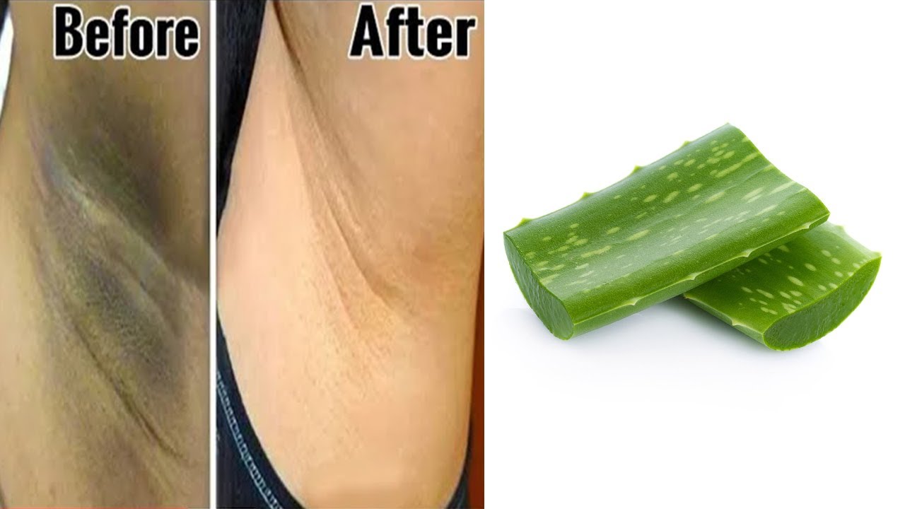 syre Sociologi Åh gud How to get rid of dark underarms overnight naturally with aloe vera | 100%  works at home - YouTube