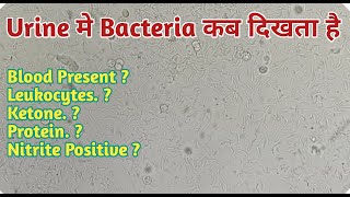 Bacterial count in urine | bacterial urine infection | bacteria in urine report | nitrite Positive