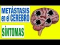 Todos los Síntomas de las Metástasis en el Cerebro