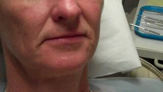 Greenbelt Dentist Recommends No Prep Veneers For Patient Missing Lateral Incisors