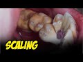 24yo. Female. SCALING | TARTAR | Dentist | Dokter Gigi Tri Putra