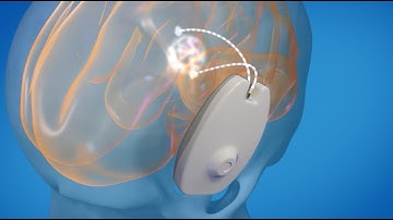 CraniUS introduces NeuroPASS: World’s first skull-embedded device for direct brain medicine delivery