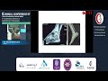 Day1 01 Pes planovalgus foot - Dr Michel Eshak Loza