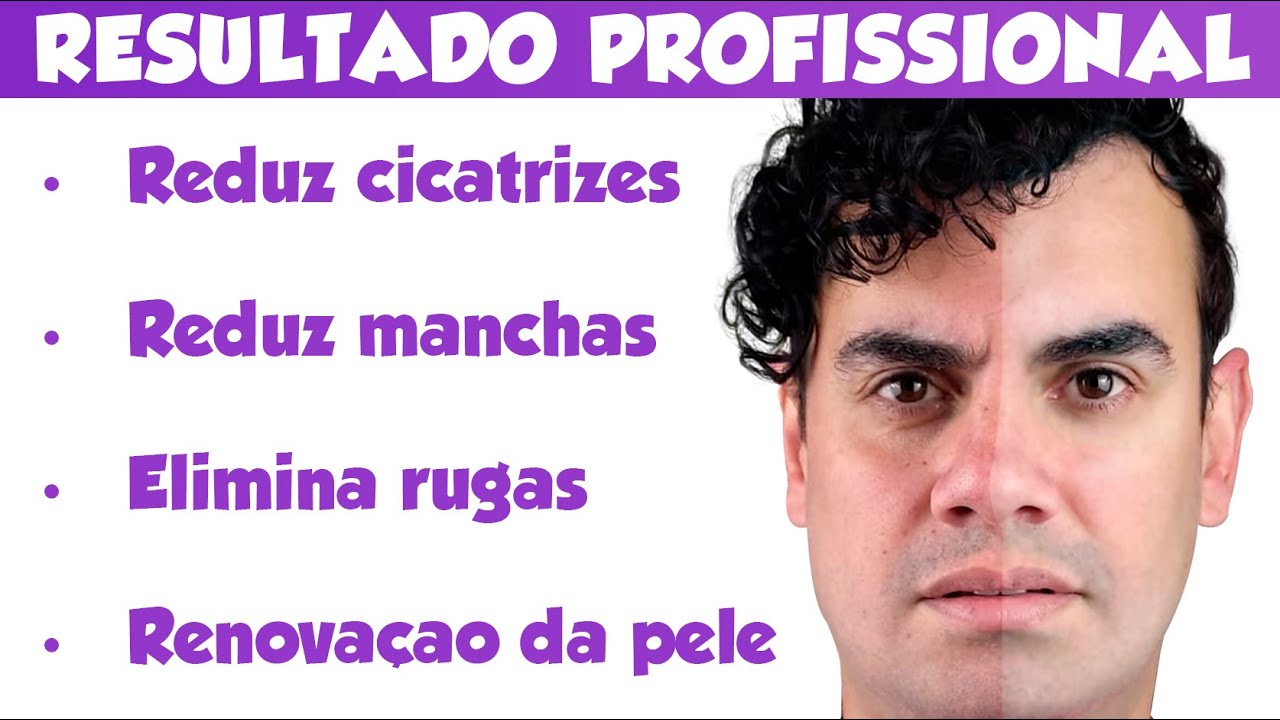 PEELING CASEIRO COM RESULTADO PROFISSIONAL - Fubá online