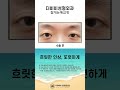 #ザビビ整形外科 👁まぶたの開きを改善し、くっきりとした印象へ