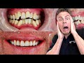 Dentist Reveals Secret That Could SAVE You 4 Teeth!