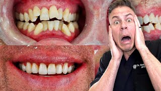 Dentist Reveals Secret That Could Save You 4 Teeth!