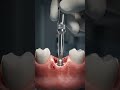 How a Missing Tooth is Replaced with an Implant 🦷 Full Dental Implant Process
