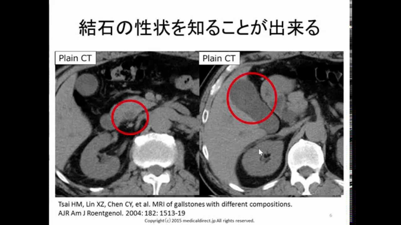 肝胆膵の画像診断：なぜCTだけではだめなのか？