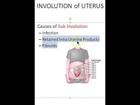 Obstetrics Causes of subinvolution Uterus Viva - YouTube