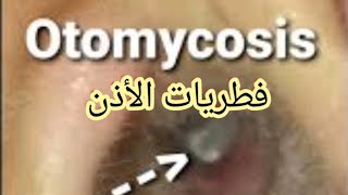 أعراض و علاج فطريات الاذن Otomycosis