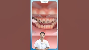 Quy Trình Gắn Mắc Cài Niềng Răng Diễn Ra Như Thế Nào ? | Bác Sĩ Yên