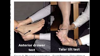Talar Tilt Test; clinical examination used to assess integrity of lateral ankle ligaments